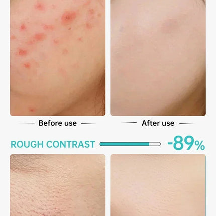 Salicylic Acid Acne Treatment Face Cream Repair Pimple Spots Deep Cleaning Pore Anti-acne Scar Oil Control Moisturizer Skin Care