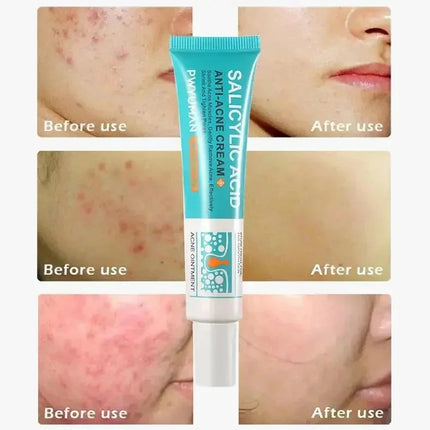 Salicylic Acid Acne Treatment Face Cream Repair Pimple Spots Deep Cleaning Pore Anti-acne Scar Oil Control Moisturizer Skin Care