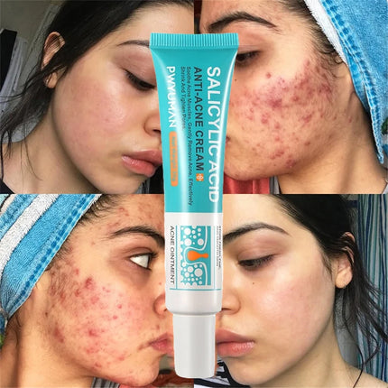 Salicylic Acid Acne Treatment Face Cream Repair Pimple Spots Deep Cleaning Pore Anti-acne Scar Oil Control Moisturizer Skin Care