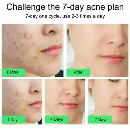 Salicylic Acid Acne Treatment Face Cream Repair Pimple Spots Deep Cleaning Pore Anti-acne Scar Oil Control Moisturizer Skin Care