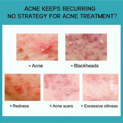 Salicylic Acid Acne Treatment Face Cream Repair Pimple Spots Deep Cleaning Pore Anti-acne Scar Oil Control Moisturizer Skin Care